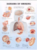 McKesson  Anatomical Chart Dangers of Smoking 20 X 26 Inch Plastic Wall Mount Laminated MK-578657