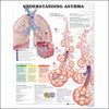McKesson Chart Understanding Asthma 20 X 26 Inch Paper Laminated MK-780784