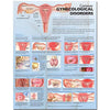 McKesson Anatomical Chart Common Gynecological Disorders 20 X 26 Inch Paper Grommets Laminated MK-781145