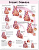 McKesson  Anatomical Chart Heart Disease 20 X 26 Inch Heavy Paper Grommets Laminated MK-800095
