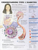 McKesson Anatomical Chart Type 1 Diabetes 20 X 26 Inch Heavy Paper Grommets Laminated MK-952245