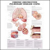 McKessonAnatomical Chart Chronic Obstructive Pulmonary Disease 20 X 26 Inch Plastic Wall Mount Laminated MK-634614