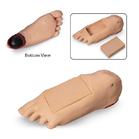 Nasco Optional Edema Foot with Deep tissue Injury Life/Form® Geri™