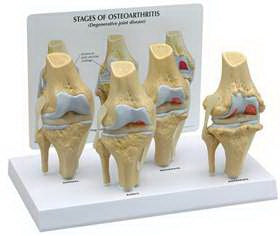 Alimed 4 Stage Osteoarthritis Knee Model GPI Anatomicals