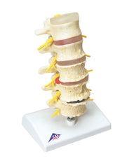Fabrication Enterprises Vertebrae Degeneration, Stages of Prolapsed Disc Model 2 lbs.