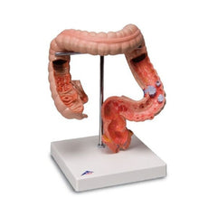 Fabrication Enterprises Intestinal Diseases Model 3B Scientific® 2.11 lbs.