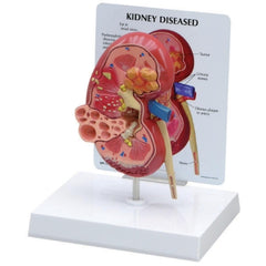 Fabrication Enterprises Diseased Kidney Model 3B Scientific®