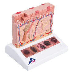 Fabrication Enterprises Skin Cancer Model 3B Scientific® .44 lbs.