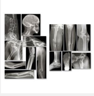 Nasco Broken Bones X-Rays Roylco®