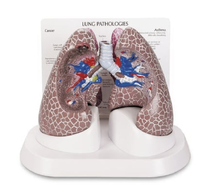 Nasco Lung Cancer Model Galloway Plastics