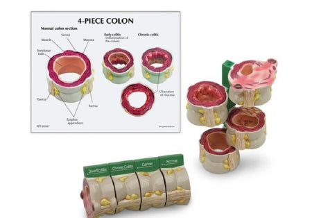 Nasco 4-Piece Colon Model with Pathologies GPI Anatomicals®