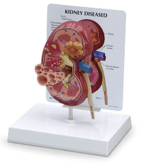 Nasco Kidney Model w/ Pathologies GPI Anatomicals®