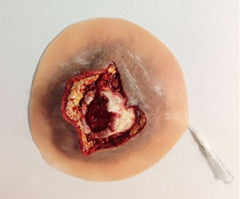 Simulaids Moulage Open Humerus Fracture Plastic