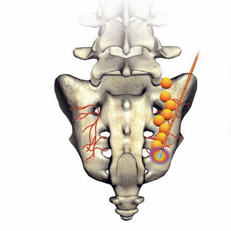 Avanos Medical Sales LLC Probe Kit SInergy™ 17 Gauge X 150 mm X 4 mm, 4 Foot L Cable - M-581939-1342 - Each