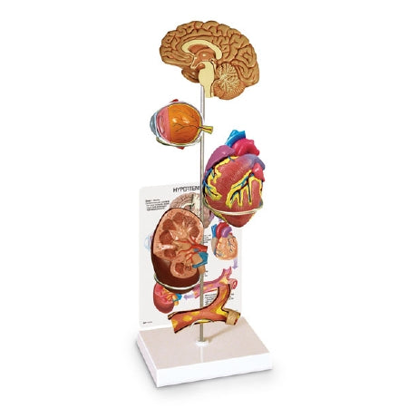 Nasco Hypertension Model Set