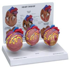 Ward's Science Heart Disease Model GPI Anatomicals