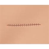 Wound Boards Stapled Incision ,1 Each - Axiom Medical Supplies