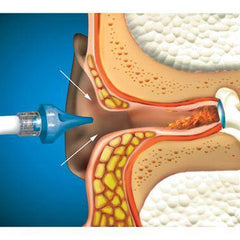 OtoClear Ear Irrigation Tip and Systems OtoClear Ear Lavage System ,1 Each - Axiom Medical Supplies