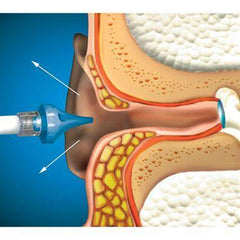 OtoClear Ear Irrigation Tip and Systems OtoClear Ear Lavage System ,1 Each - Axiom Medical Supplies