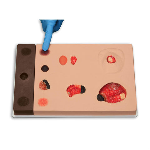 Pat Pressure Injury Staging Model Pat Pressure Injury Staging Model ,1 Each - Axiom Medical Supplies