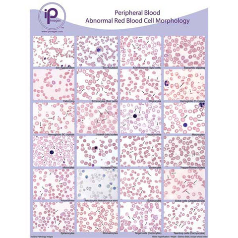 Peripheral Blood Cards and Posters Abnormal WBC Morphology Binder Cards ,10 / pk - Axiom Medical Supplies