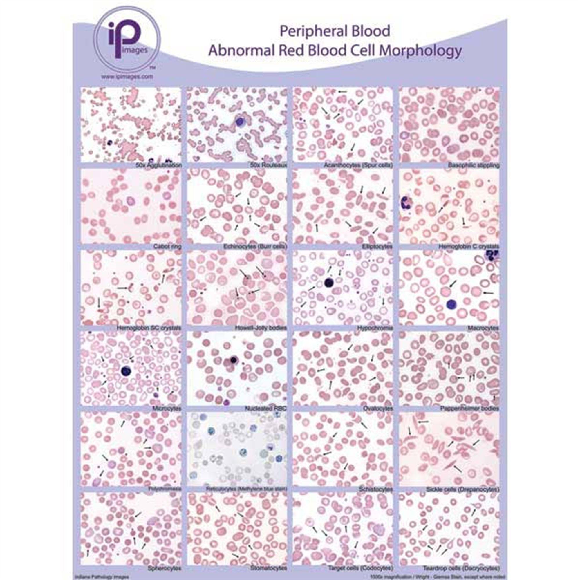 Peripheral Blood Cards and Posters Abnormal RBC Morphology Poster ,1 E ...