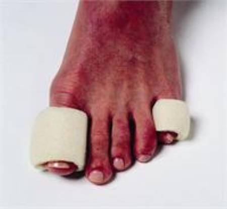 Pedifix Toe Bandage Pedifix Pull On Toe